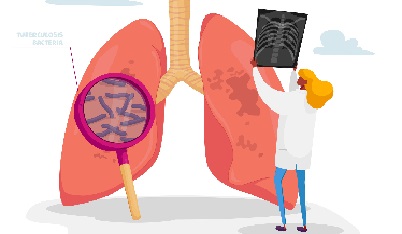 Tuberculosis Exam illustration.